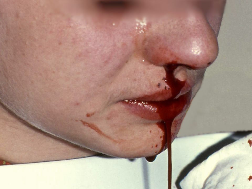 A person with an active nosebleed and blood visible below the nostril.