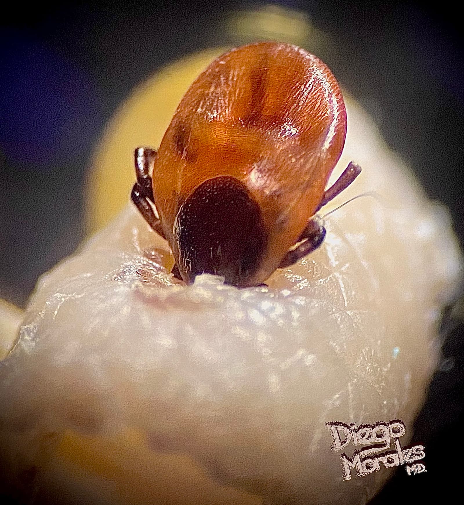 一张医学照片，显示一只雌性 Ixodes 鹿蜱正在钻入小块皮肤标本。