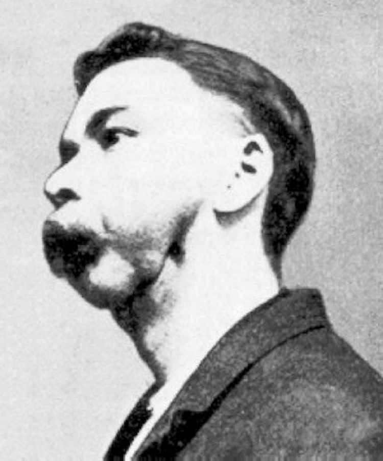Archival 1899 photograph of a match factory worker with phosphorus necrosis of the jaw.