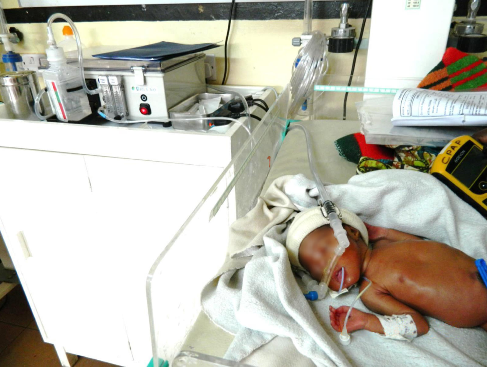 Clinical photograph of a newborn receiving bubble CPAP through short nasal prongs on a neonatal ward in Blantyre, Malawi.