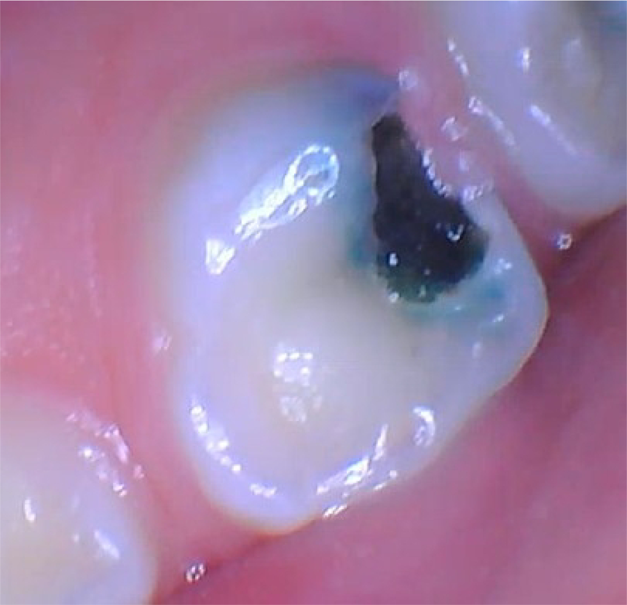 Close clinical photograph of a molar with a black cavitated lesion that remained active during an SDF clinical trial.