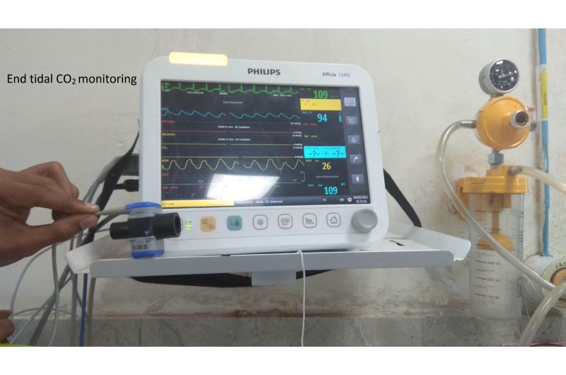A hand holds an airway connector and capnography sensor beside a bedside monitor and breathing tubing.